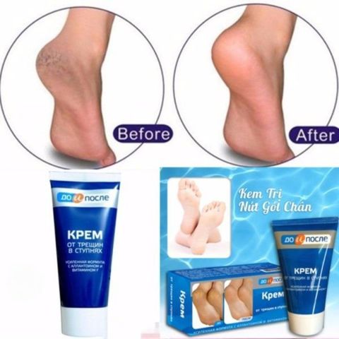 Kem Nứt Gót Chân KPem Nga 50ml – Làm Mềm Da, Giảm Nứt Nẻ, Dưỡng Ẩm Sâu, Phục Hồi Gót Chân Khô Ráp 388358