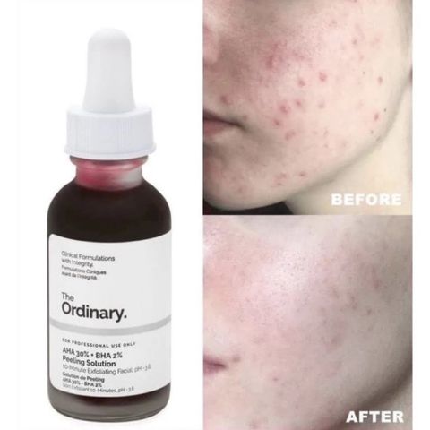 Serum Tẩy Tế Bào Chết The Ordinary AHA 30% + BHA 2% - Giải Pháp Chăm Sóc Da Mụn, Làm Sáng Da và Se Khít Lỗ Chân Lông 30ml