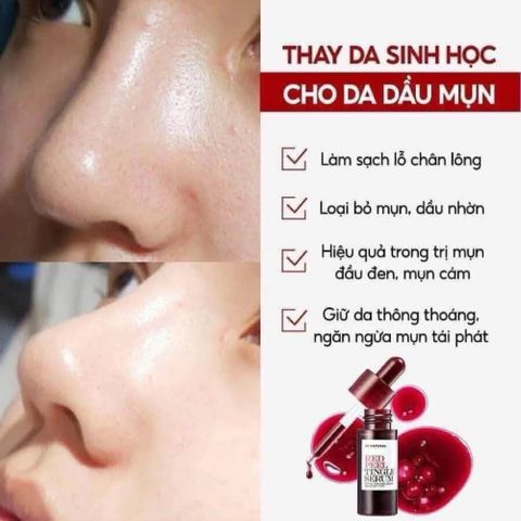 Tinh Chất Serum Red Peel Tingle So Natural 35ml - Tẩy Tế Bào Chết Hóa Học, Làm Sáng & Mịn Da, Giúp Thu Nhỏ Lỗ Chân Lông