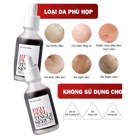 Tinh Chất Serum Red Peel Tingle So Natural 35ml - Tẩy Tế Bào Chết Hóa Học, Làm Sáng & Mịn Da, Giúp Thu Nhỏ Lỗ Chân Lông