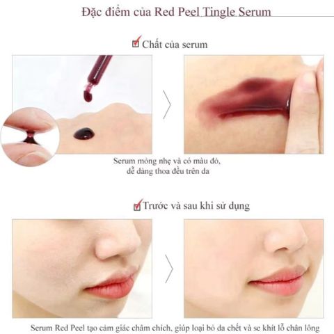 Tinh Chất Serum Red Peel Tingle So Natural 35ml - Tẩy Tế Bào Chết Hóa Học, Làm Sáng & Mịn Da, Giúp Thu Nhỏ Lỗ Chân Lông