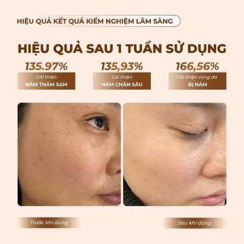 Bộ Serum & Kem Nám Mommy Care Perilla Whitening – Dưỡng Sáng Da, Giảm Nám, Cấp Ẩm, Chăm Sóc Da Mặt Hàn Quốc 50ml & 50g/80g