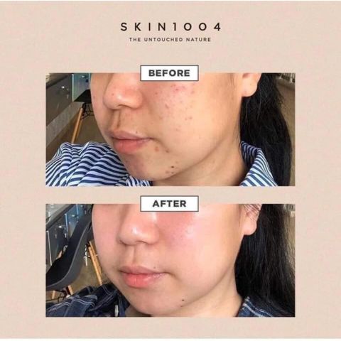 Tinh Chất Serum Rau Má Skin1004 Madagascar Centella Ampoule 100ml - Chăm Sóc Da Mụn, Nhạy Cảm, Giải Quyết Vấn Đề Da Nhanh Chóng