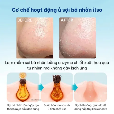 Tinh Chất Ủ Mụn Đầu Đen Softener + Bông Cotton 1/3 Tiết Kiệm – Làm Sạch Mụn, Dưỡng Da Dịu Nhẹ 388581