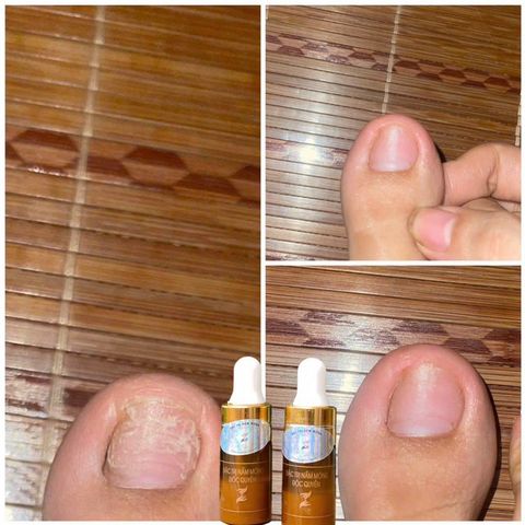 Serum Dưỡng Cứng Móng 4ml - Giải Quyết Nấm Móng, Hư Khoé, Bọng Móng - Sản Phẩm Gia Truyền Hiệu Quả