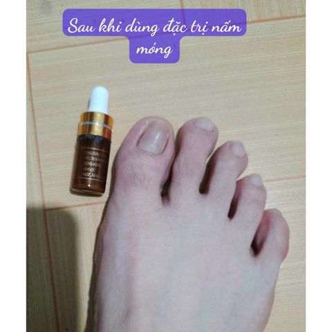 Combo Serum Chăm Sóc Móng - Đánh Bay Nấm Móng, Hư Khóe, Phục Hồi Móng Hư Tổn Cho Tay Chân Mềm Mại, Ngừa Bọng Móng