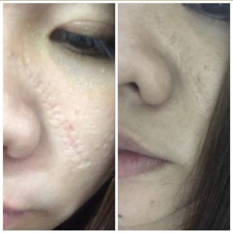 Combo 2 Cao Xoá Sẹo Collagen Giúp Làm Mờ Sẹo Lồi, Lõm và Hỗ Trợ Làm Lành Vết Thương Nhanh Chóng, Căng Bóng Da
