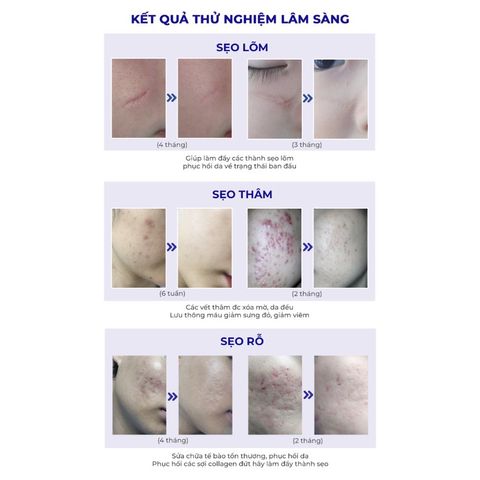Combo 2 Cao Xoá Sẹo Collagen Giúp Làm Mờ Sẹo Lồi, Lõm và Hỗ Trợ Làm Lành Vết Thương Nhanh Chóng, Căng Bóng Da