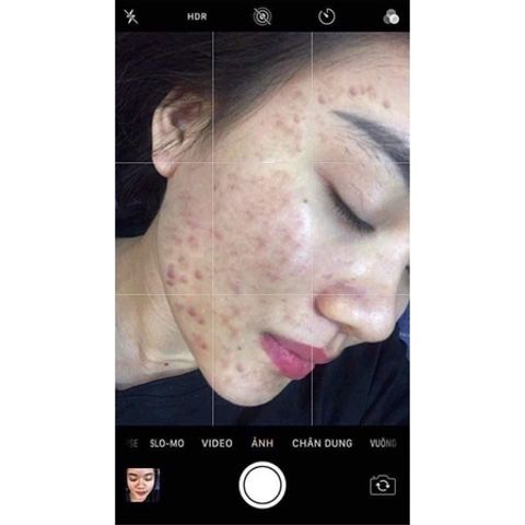 Serum Giảm Mụn Thâm Rỗ Skin 7 Days - Hiệu Quả 5 Trong 1 Cho Làn Da Sáng Khỏe Từ Thiên Nhiên, An Toàn Cho Da Nhạy Cảm