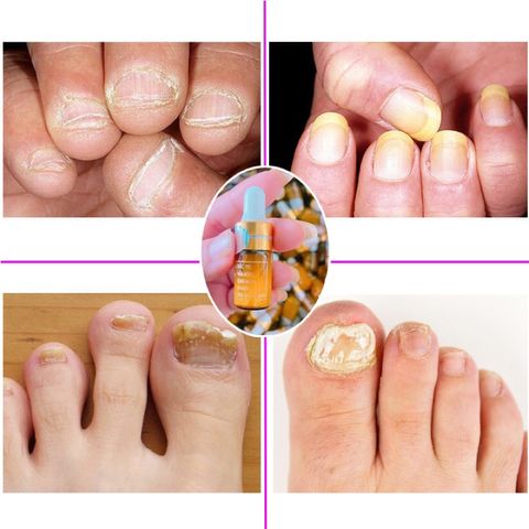 Combo 5 Chai Serum Phục Hồi Móng - Chữa Nấm Móng và Hư Khóe, Giải Quyết Bọng Móng, Dễ Dàng Sử Dụng 4ml