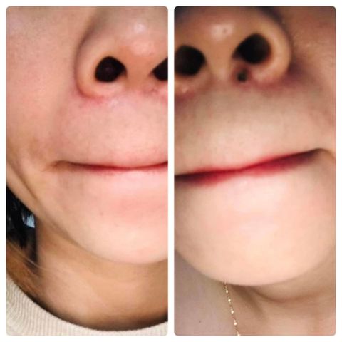 Gel Tẩy Nốt Ruồi Dvelinil - Xóa Mụn Cóc, Mụn Thịt & Sẹo Lồi An Toàn Tại Nhà - Cam Kết Chính Hãng, Hiệu Quả Ngay Lần Đầu Sử Dụng