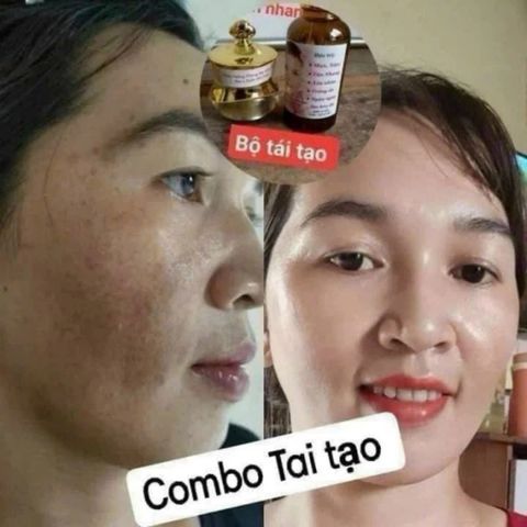 Combo Kem Face và Serum Tái Tạo Da Gia Truyền - Giúp Da Căng Bóng Mịn Màng, Khắc Phục Nám Mụn Tàn Nhang Chuyên Sâu