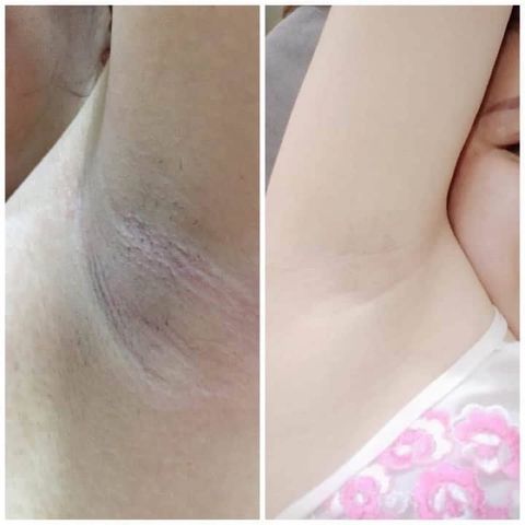 Combo 10 Kem Hết Hôi Nách Gluta Milk - Dưỡng Trắng, Khử Thâm, Chống Mùi Hiệu Quả Cho Vùng Nách, Mông, Bẹn, An Toàn Cho Da