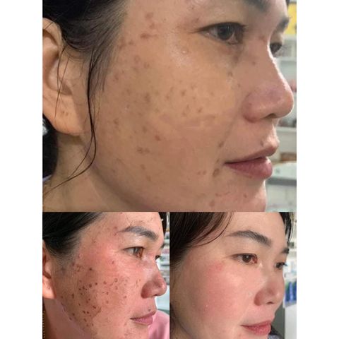 Gel Tẩy Nốt Ruồi Collagen Tại Nhà - Xóa Mụn Cơm, Đồi Mồi, Sẹo Lồi - Da Mịn Màng, Sạch Sẽ, Không Để Lại Sẹo