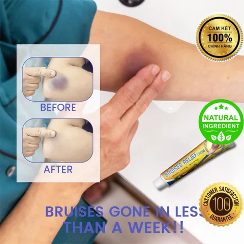 Kem Bôi Vết Bầm, Vết Thâm Dưới Da - Mega Care 100% Tự Nhiên, Giảm Sưng Tấy, Phục Hồi Da Tổn Thương Hiệu Quả