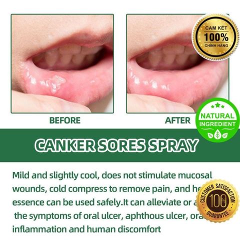 Chai Xịt Nhiệt Miệng Thảo Mộc - Giảm Đau, Ngăn Ngừa Lở Miệng và Loét Miệng - Kháng Khuẩn Tự Nhiên An Toàn cho Răng Miệng