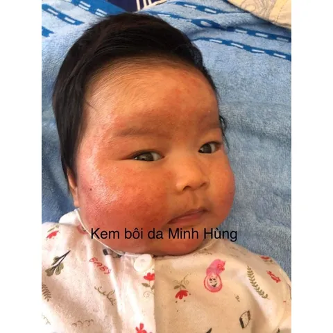 Kem Bôi Da Minh Hùng Chính Hãng - Chăm Sóc Da Bé, Tái Tạo Da, Chống Ngứa, Dành Cho Trẻ Sơ Sinh và Hỗ Trợ Điều Dị Ứng Da