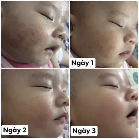 Kem Bôi Da Minh Hùng Chính Hãng - Chăm Sóc Da Bé, Tái Tạo Da, Chống Ngứa, Dành Cho Trẻ Sơ Sinh và Hỗ Trợ Điều Dị Ứng Da