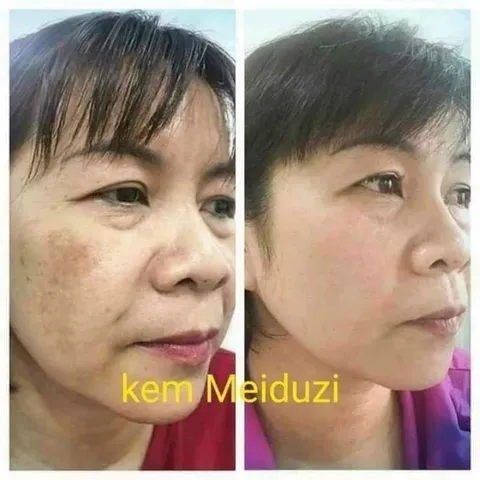Combo Kem Dưỡng Trắng Da MEIDUZI Xanh Đỏ Ngày Và Đêm - Mờ Thâm Sạm, Nám Mụn 20Gram - Chăm Sóc Da Từ Thiên Nhiên Nhật Bản