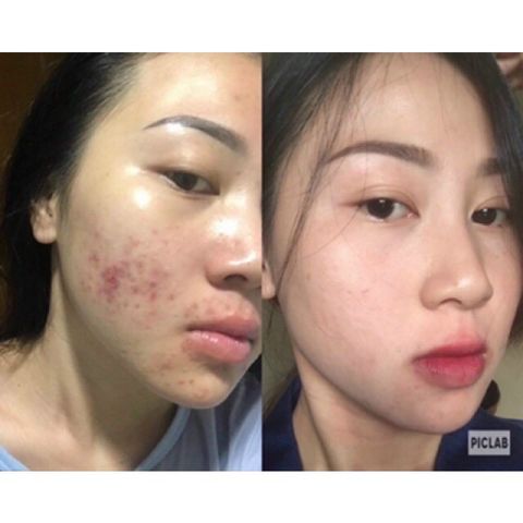 Serum Mụn Detox - Làm Sạch Mụn Ẩn, Mụn Đầu Đen, Mờ Thâm Nám, Sáng Da, Kháng Khuẩn, Cấp Ẩm Tốt