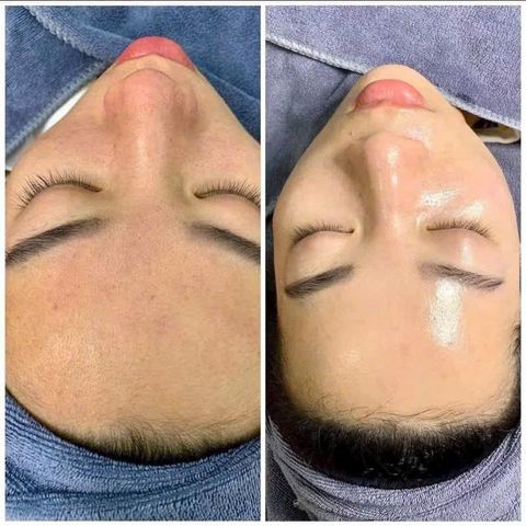 Vi Gai Meso Collagen Siêu Nhỏ - Xoá Nếp Nhăn, Tăng Độ Đàn Hồi, Dưỡng Trắng Da Sáng Mịn, Làm Sạch Lỗ Chân Lông, Chăm Sóc Da Hiệu Quả