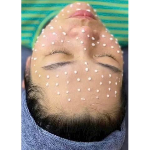 Vi Gai Meso Collagen Siêu Nhỏ - Xoá Nếp Nhăn, Tăng Độ Đàn Hồi, Dưỡng Trắng Da Sáng Mịn, Làm Sạch Lỗ Chân Lông, Chăm Sóc Da Hiệu Quả
