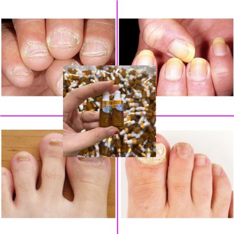 Combo 5 Lọ Serum Nấm Móng Tay Chân - Điều Trị Bọng Móng và Hư Khoé, Dưỡng Cứng Móng Gia Truyền 4ml