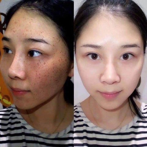 Tuýp Kem Mờ Nám Clobetamil G Thái Lan 25g - Làm Mờ Nám, Tàn Nhang Hiệu Quả, Da Sáng Mịn, Dưỡng Ẩm cho Làn Da Khỏe Mạnh