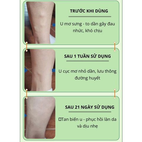 Kem Bôi Tan U Mỡ Thảo Mộc Sumifun - Giảm Sưng Đau, Loại Bỏ U Lớn, Da Khỏe Mạnh Tự Nhiên, Chiết Xuất 9 Loại Thảo Mộc Quý