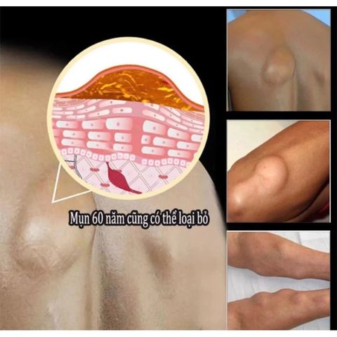 Kem Bôi Tan U Mỡ Thảo Mộc Sumifun - Giảm Sưng Đau, Loại Bỏ U Lớn, Da Khỏe Mạnh Tự Nhiên, Chiết Xuất 9 Loại Thảo Mộc Quý