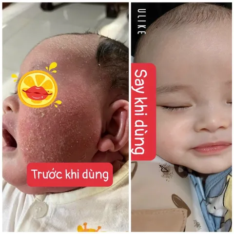 Kem Bôi Da Chống Nẻ Gót Chân Thẩm Thấu Nhanh - Dưỡng Ẩm Da Mềm Mịn Thiên Di, Hủ 8gr, Phù Hợp Mọi Loại Da