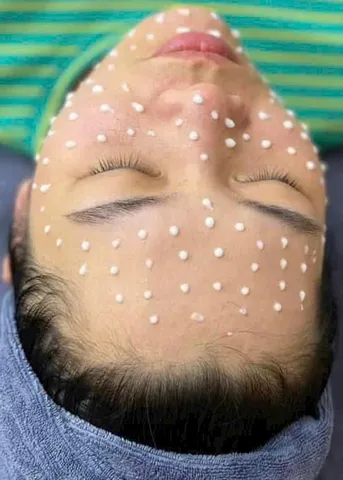 Vi Gai Meso Collagen 10ml - Kem Dưỡng Da Căng Bóng, Ngăn Ngừa Lão Hóa, Làm Mờ Thâm Nám, Tàn Nhang, Da Mịn Màng Sáng Khỏe