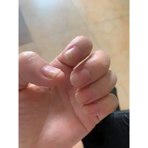 Combo 10 Lọ Serum Dưỡng Móng Chân Tay, Chữa Hư Khoé và Bọng Móng, Nước Ăn Móng Gia Truyền 4ml - Hiệu Quả Nhanh Chóng