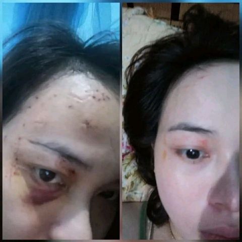 Cao Xoá Sẹo Collagen 10gr - Mờ Sẹo Lồi Lõm, Hỗ Trợ Lành Vết Thương, Trẻ Hóa Da, Ngăn Ngừa Lão Hóa, Da Trắng Hồng Căng Bóng