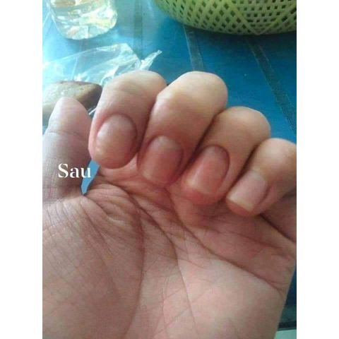 Serum Đánh Bay Nấm Móng và Hư Khoé - Nước Ăn Tay Chân Gia Truyền 4ml - Giải Pháp Cho Móng Hư Tổn, Freeship Toàn Quốc