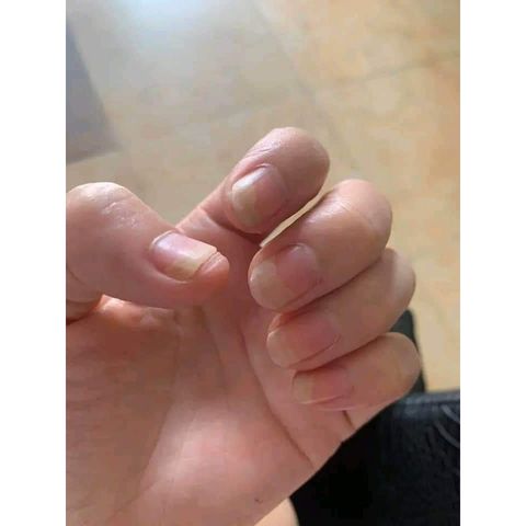 Serum Đánh Bay Nấm Móng và Hư Khoé - Nước Ăn Tay Chân Gia Truyền 4ml - Giải Pháp Cho Móng Hư Tổn, Freeship Toàn Quốc