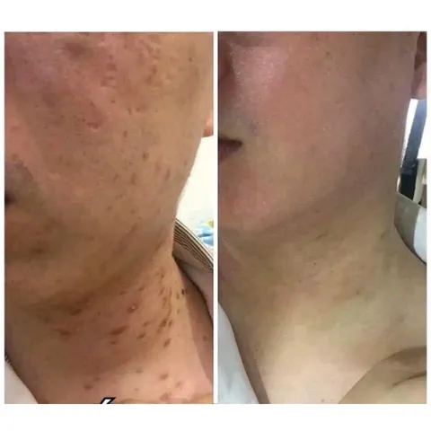Cao Xoá Sẹo Collagen Mờ Sẹo Lồi Lõm - Giải Pháp Làm Lành Vết Thương Nhanh, Ngăn Ngừa Lão Hóa Da, Tăng Độ Đàn Hồi