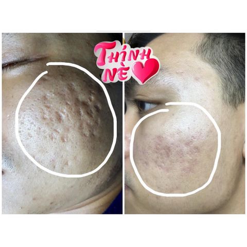 Combo 2 Lọ Cao Xoá Sẹo Collagen Mờ Sẹo Lồi Lõm - Giúp Nhanh Lành Vết Thương, Không Để Lại Sẹo cho Mẹ Bầu và Mẹ Bỉm