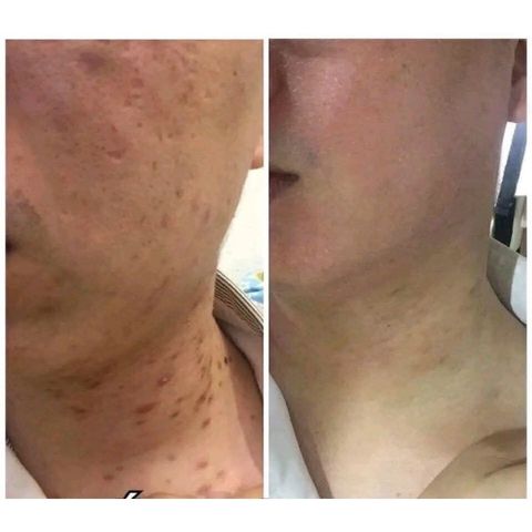 Combo 2 Lọ Cao Xoá Sẹo Collagen Mờ Sẹo Lồi Lõm - Giúp Nhanh Lành Vết Thương, Không Để Lại Sẹo cho Mẹ Bầu và Mẹ Bỉm