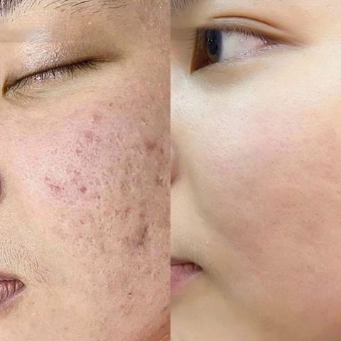Combo 2 Lọ Cao Xoá Sẹo Collagen Mờ Sẹo Lồi Lõm - Giúp Nhanh Lành Vết Thương, Không Để Lại Sẹo cho Mẹ Bầu và Mẹ Bỉm