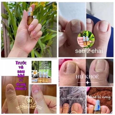 Combo 10 Serum Chống Nấm Móng & Hư Khoé - Giảm Đau & Hiệu Quả Nhanh 4ml, Phù Hợp Cho Nail Salon