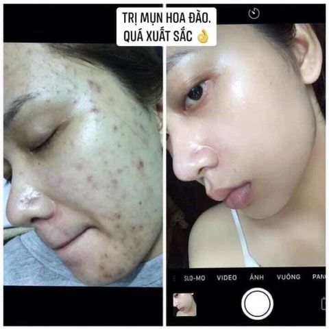Kem Mụn Đông Y Hoa Đào Chính Hãng - Giảm Mụn, Mờ Vết Thâm, Dưỡng Trắng Da Tự Nhiên, An Toàn Cho Mọi Loại Da