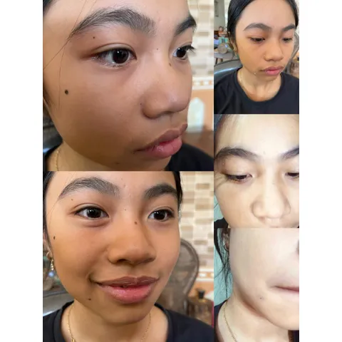 Kem Tẩy Nốt Ruồi Độc Quyền - Giải Pháp Xóa Mụn Cóc, Mụn Thịt & Sẹo Lồi An Toàn Tại Nhà, Da Mịn Màng, Không Để Lại Vết Thâm