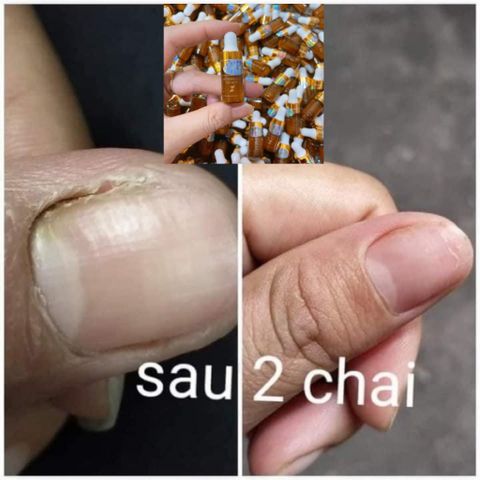 Combo 3 Chai Serum Chăm Sóc Móng Tay Chân - Trị Nấm Móng, Hư Khoé, Dưỡng Dài Móng Khỏe, 4ml