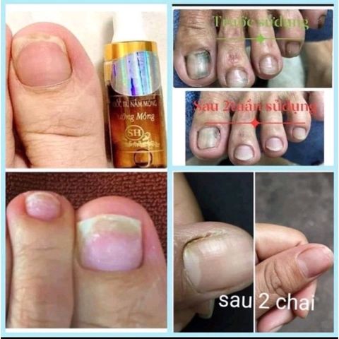 Combo 3 Chai Serum Chăm Sóc Móng Tay Chân - Trị Nấm Móng, Hư Khoé, Dưỡng Dài Móng Khỏe, 4ml