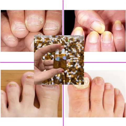 Combo 3 Chai Serum Chăm Sóc Móng Tay Chân - Trị Nấm Móng, Hư Khoé, Dưỡng Dài Móng Khỏe, 4ml
