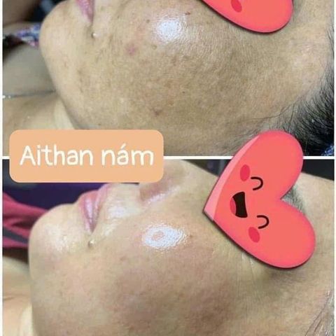 Bộ sản phẩm giảm thâm nám AiThan - Kem dưỡng trắng da, làm sáng và làm mờ vết nám hiệu quả, giá trị cho làn da khỏe đẹp.