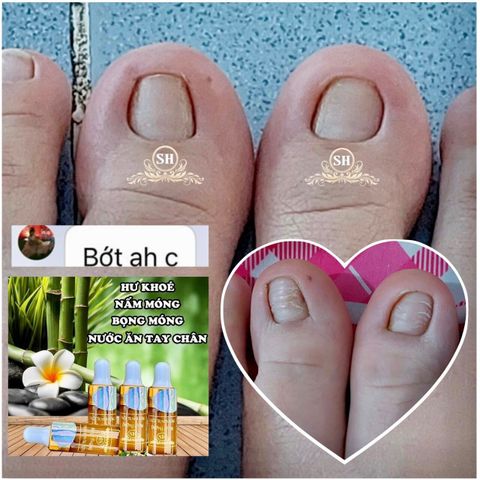 Serum Phục Hồi Móng - Combo 2 Chai 4ml Trị Nấm Móng, Hư Khoé, Bọng Móng - Giải Pháp Chăm Sóc Móng Chân Tay Hiệu Quả