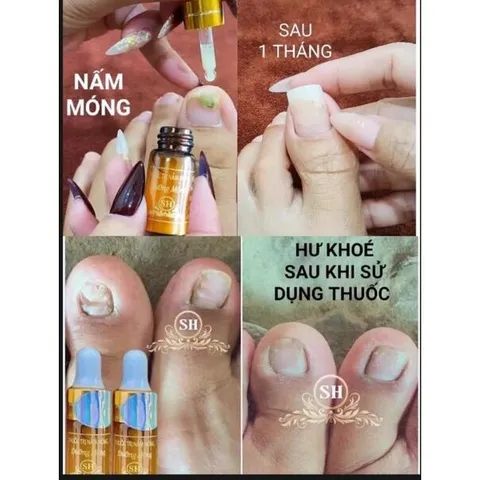 Serum Phục Hồi Móng - Combo 2 Chai 4ml Trị Nấm Móng, Hư Khoé, Bọng Móng - Giải Pháp Chăm Sóc Móng Chân Tay Hiệu Quả