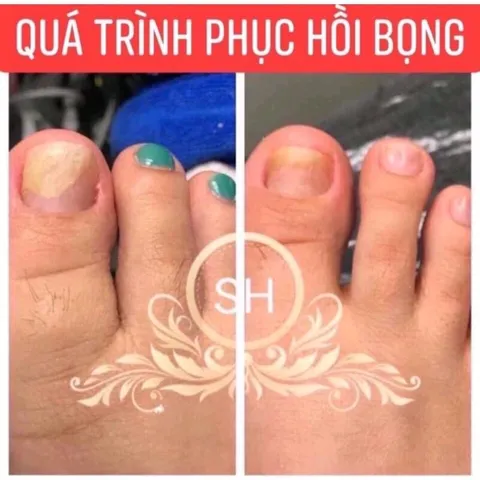 Serum Phục Hồi Móng - Combo 2 Chai 4ml Trị Nấm Móng, Hư Khoé, Bọng Móng - Giải Pháp Chăm Sóc Móng Chân Tay Hiệu Quả